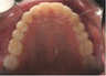 Invisalign Treatment