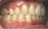 Invisalign Treatment
