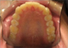 Invisalign Treatment