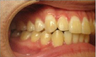 Invisalign Treatment