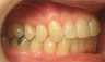 Invisalign Treatment