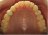 Invisalign Treatment