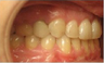 Invisalign Treatment