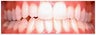 Invisalign