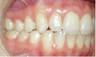 Invisalign 24 Months Severe Over Jet and Tongue Thrust