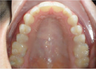 Invisalign 24 Months Severe Over Jet and Tongue Thrust