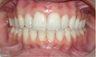 Invisalign 24 Months Severe Over Jet and Tongue Thrust