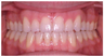 Invisalign