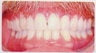 Low incisor extraction