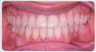 Anterior Crossbite