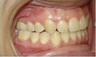 Invisalign Treatment