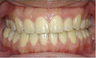 Invisalign Treatment