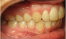 Invisalign Treatment