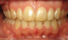 Invisalign Treatment