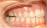 Invisalign Treatment