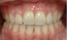 Invisalign Treatment