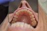 Moderate anterior crowding treated with Invisalign
