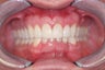 Invisalign