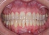 Invisalign