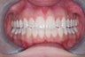 Invisalign