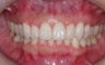 Invisalign