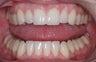 Invisalign
