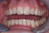 Invisalign