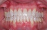 Invisalign