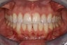 Invisalign