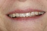 Invisalign and Cosmetic Bonding