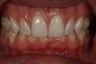 Invisalign