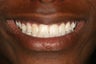 Invisalign
