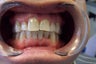 Invisalign