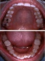 Invisalign