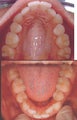 Invisalign