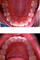 Invisalign