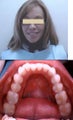 Invisalign