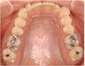 Invisalign