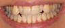 Invisalign