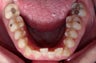 Invisalign