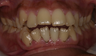 Invisalign