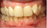 Invisalign