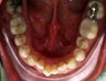 Invisalign