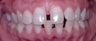 Invisalign