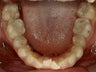 Invisalign