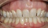 Invisalign used to correct flaring and overlapping teeth