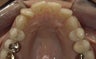 Invisalign: dramatic rotation of front teeth
