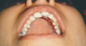 The Hollywood smile with Invisalign