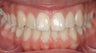 Upper Jaw Expander, Invisalign