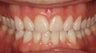 Braces and Invisalign